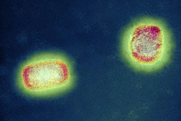 การทดสอบ Fast Antigen: Monkeypox จะถูกทอดทิ้งโดยโลกกลายเป็นโรคติดเชื้อครั้งต่อไปหรือไม่?